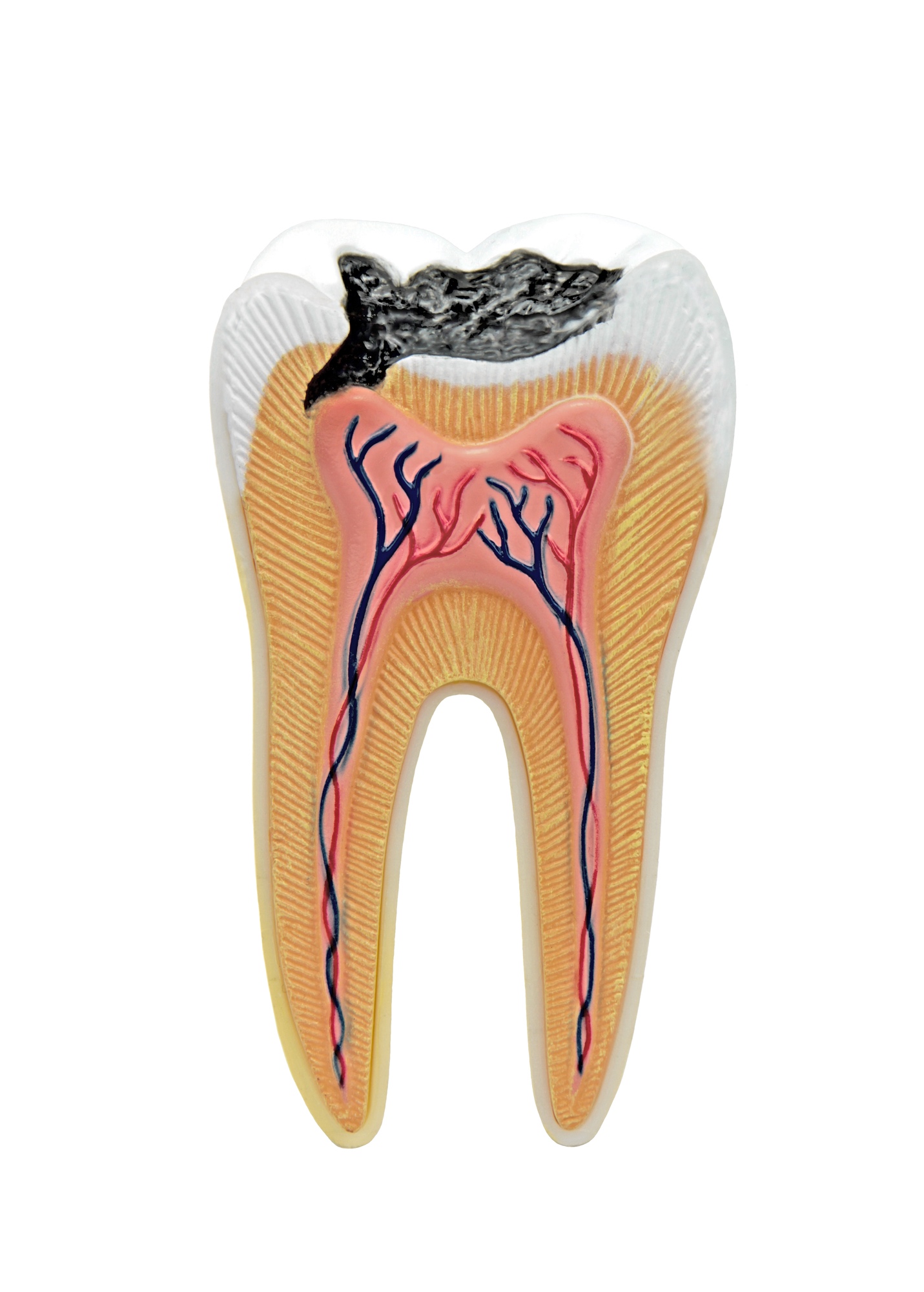 Zahn mit Karies im Querschnitt