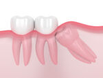 3d render of jaw with wisdom mesial impaction
