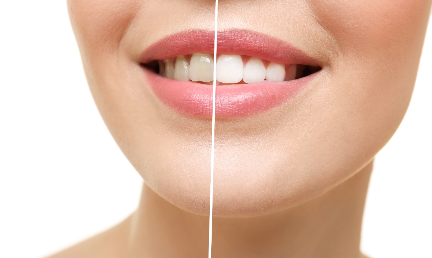 Ergebnis einer Zahnaufhellung. Lächelnde junge Frau auf weiße