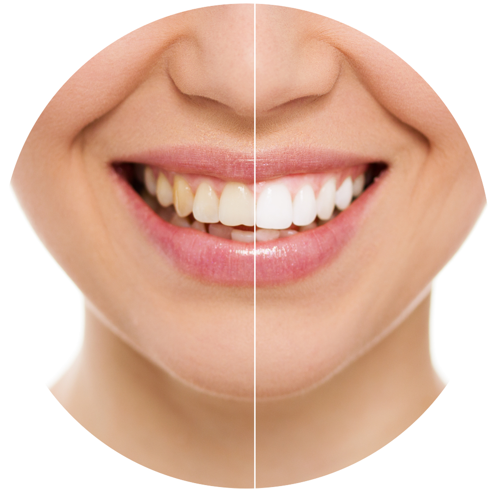 Professionelle Zahnreinigung Erwachsene Zahnprophylaxe