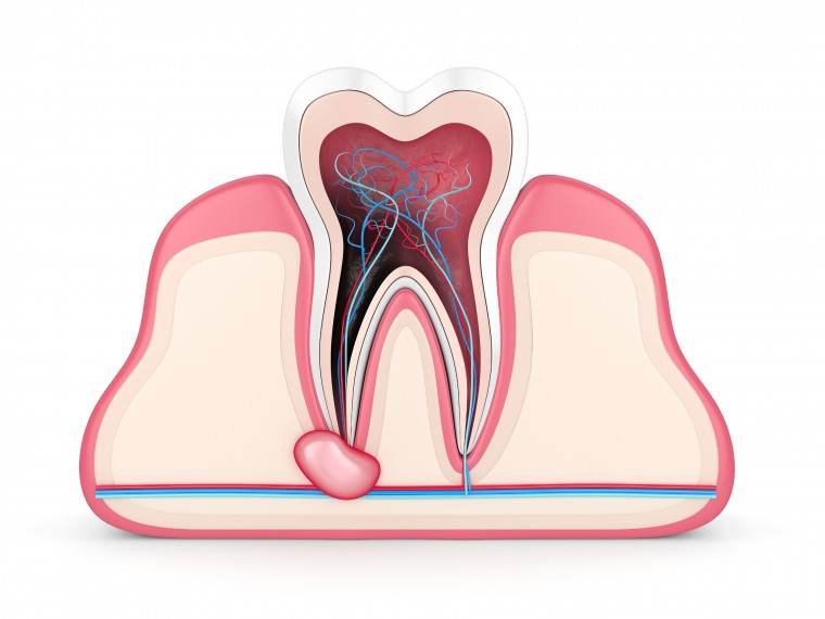 Zahn im Zahnfleisch mit Zyste - Wurzelspitzenresektion
