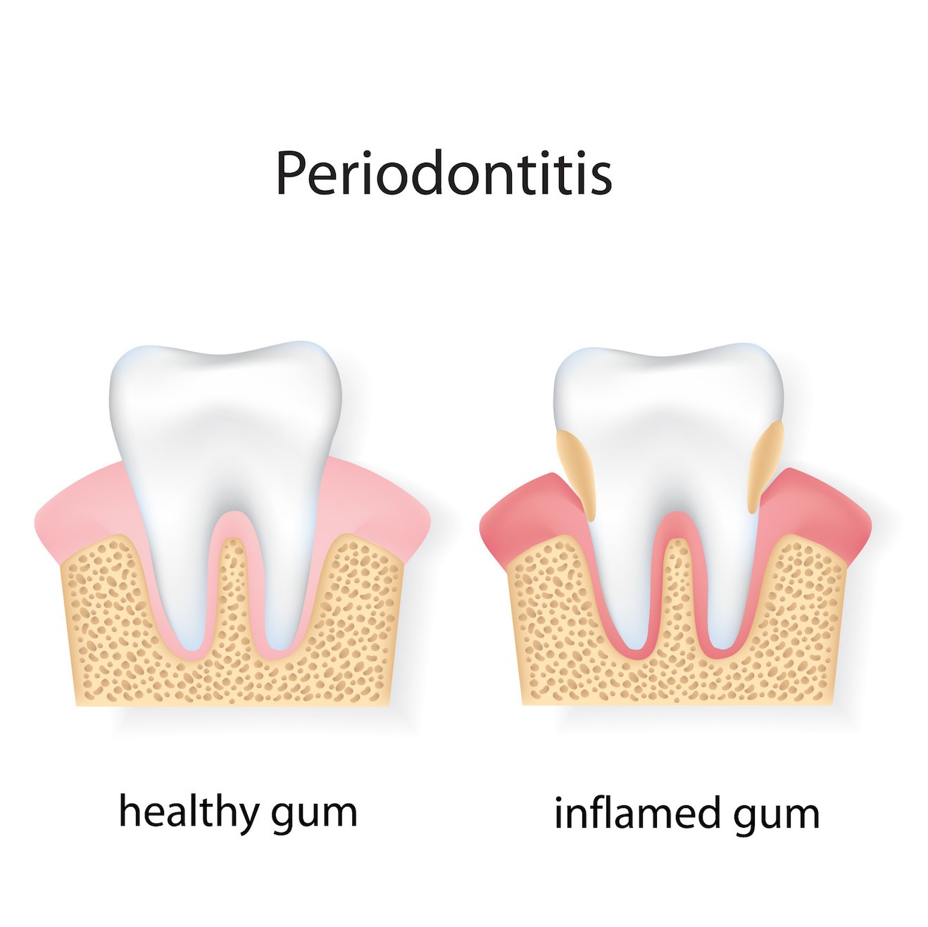 Parodontitis-Gesundes-Krankes-Zahnfleisch