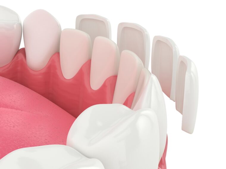 Zaehne und Veneers