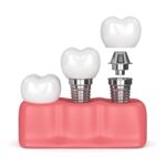 3d render of dental implants in gums over white background