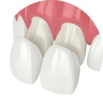 3D-Darstellung des Oberkiefers mit Veneers