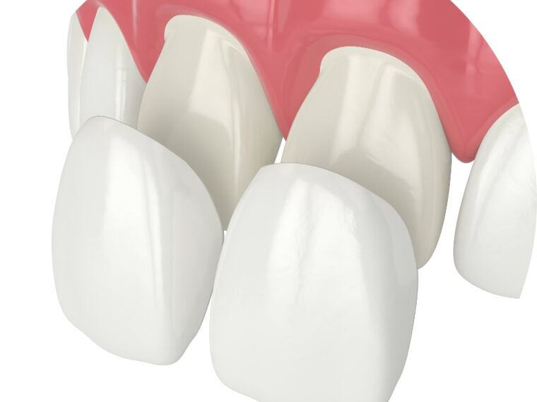 Veneers