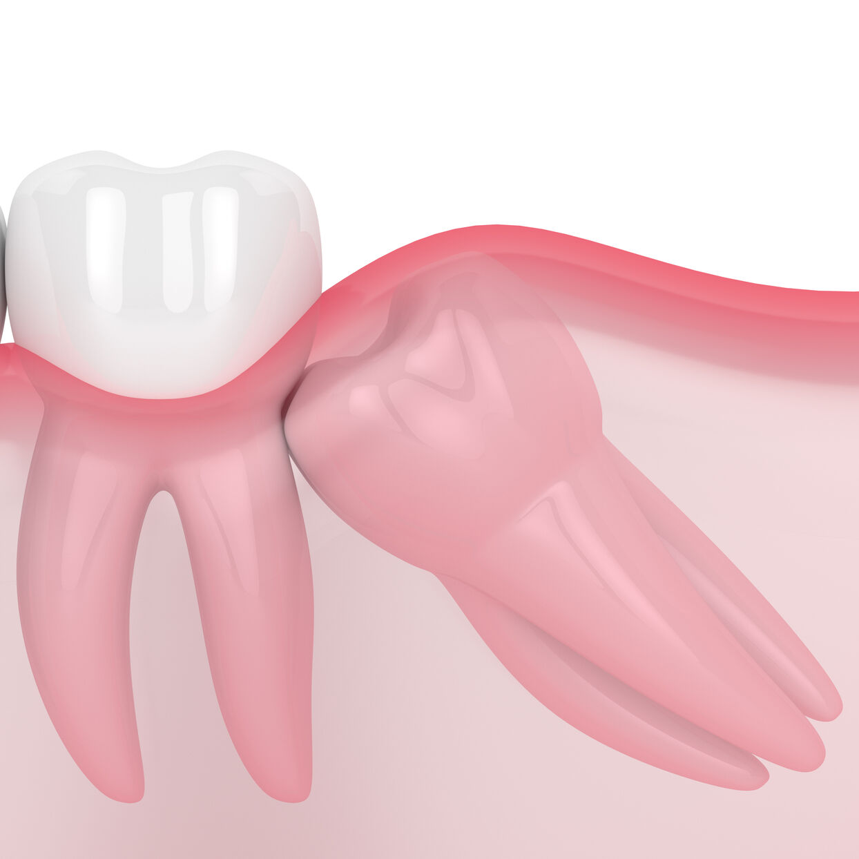 3d-Rendering eines Kiefers mit mesialer Weisheitsimpaktion 3d-Rendering eines Kiefers mit mesialer Weisheitsimpaktion