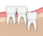 3d render of teeth with wisdom vertical impaction. Concept of different types of wisdom teeth impactions.