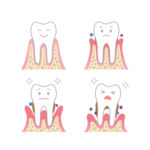 parodontitis-stufen-Krankheit-Illustration-Zahn-mundhygiene-zahnpflege